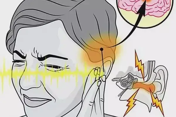 Illustration connected to nerve inflammation and tinnitus